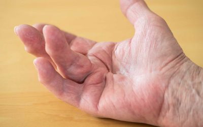 Dupuytren Kontraktur