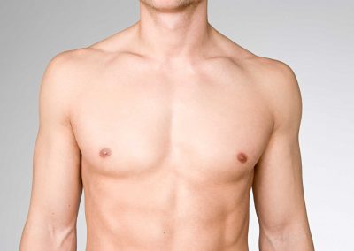 Gynäkomastie